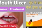 Mouth Ulcer Treatment 2025