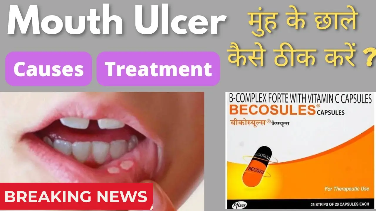 Mouth Ulcer Treatment 2025